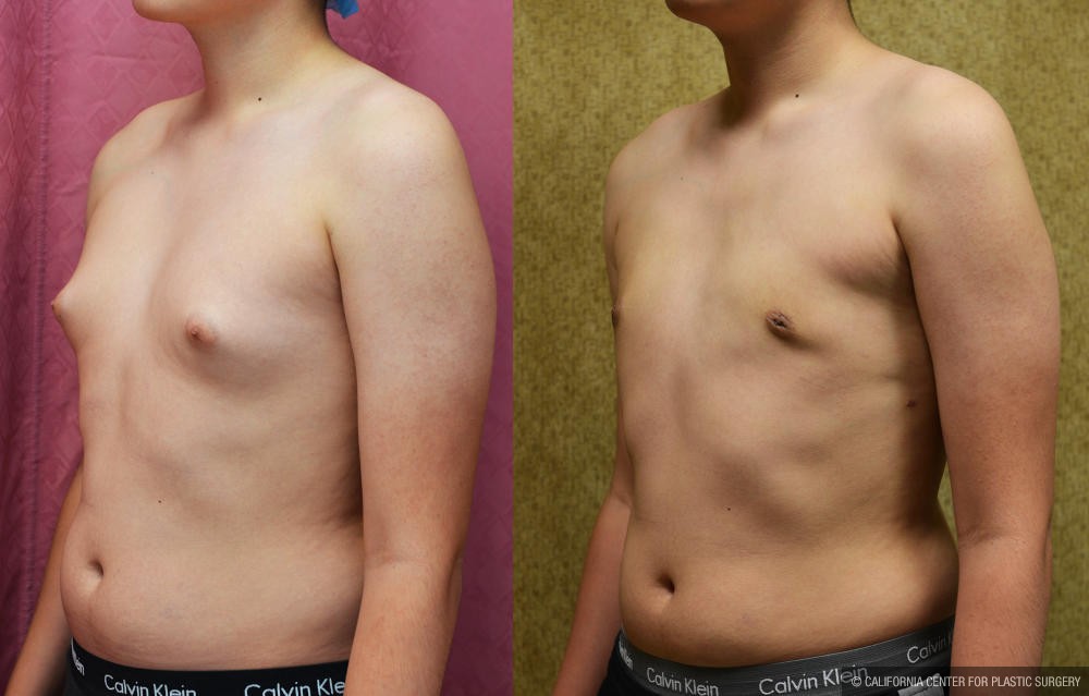 Male gynecomastia (breast) reduction Before & After Patient #12186