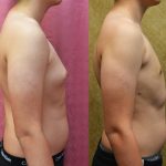 Male gynecomastia (breast) reduction Before & After Patient #12186