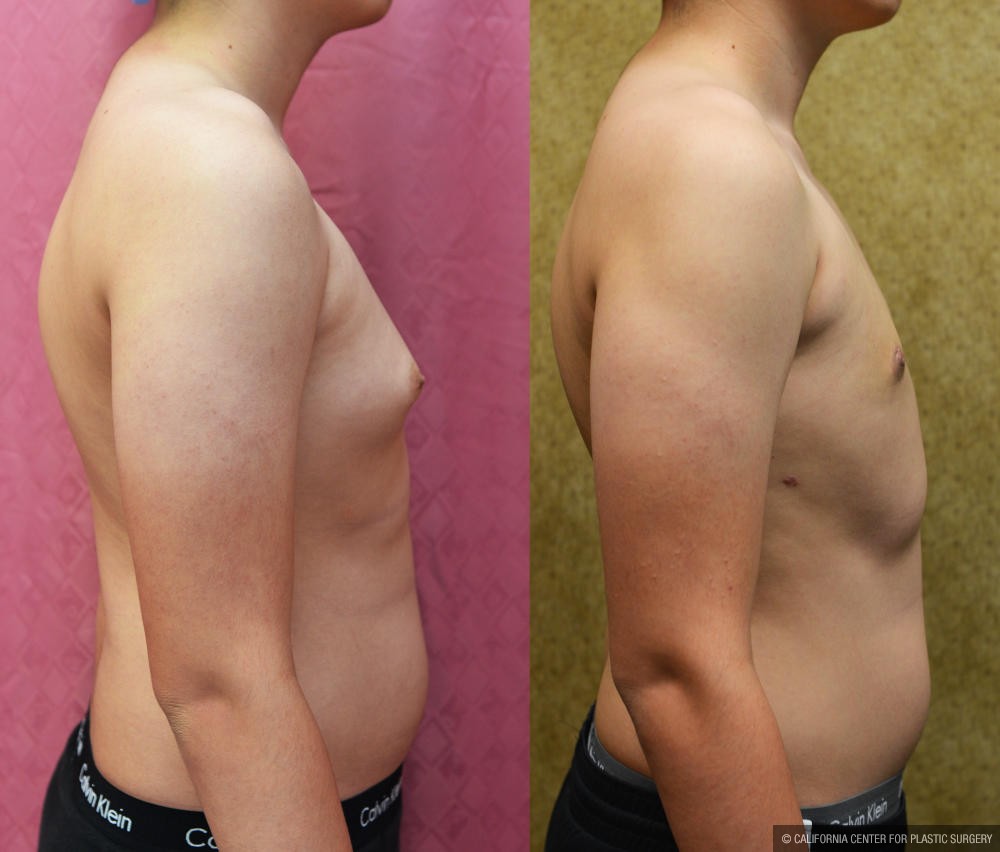 Male Breast Reduction Before & After Patient #12186