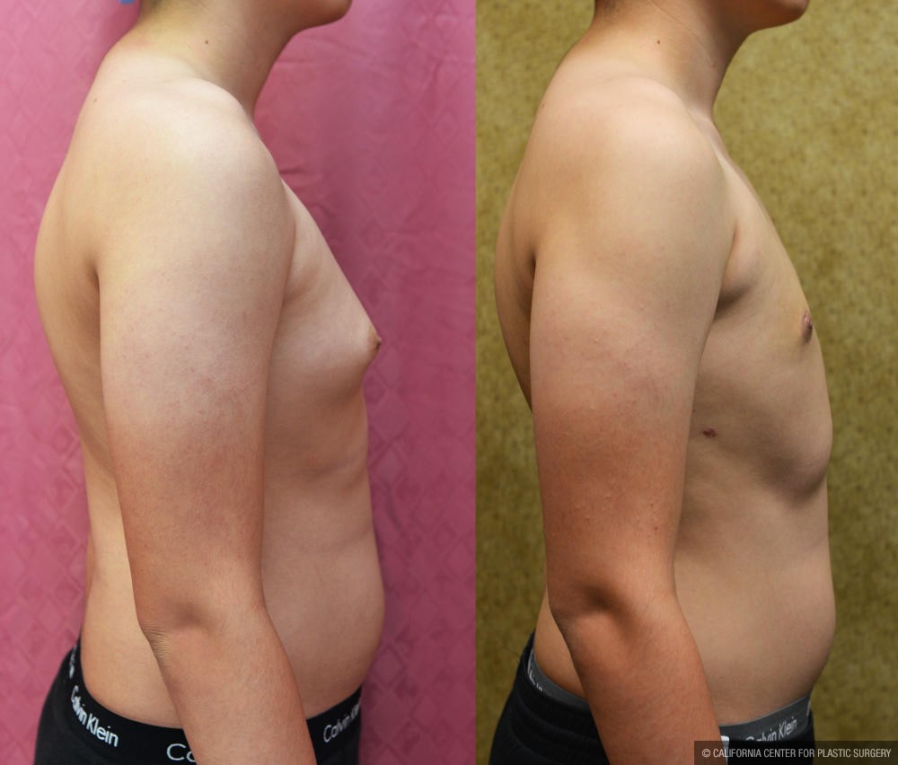 Male gynecomastia (breast) reduction Before & After Patient #12186