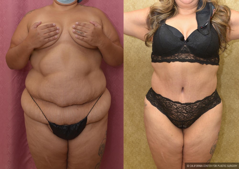 Tummy Tuck (Abdominoplasty) Plus Size Before & After Patient #12216
