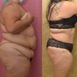 Tummy Tuck (Abdominoplasty) Plus Size Before & After Patient #12216