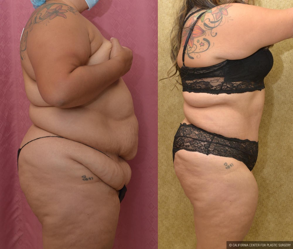 Tummy Tuck Plus Size Before & After Patient #12216