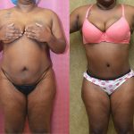 African American Tummy Tuck (Abdominoplasty) Before & After Patient #12190