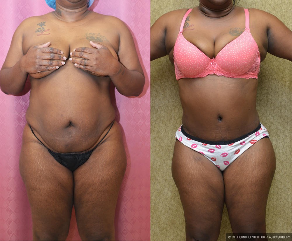 African American Tummy Tuck (Abdominoplasty) Before & After Patient #12190