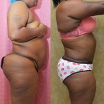 African American Tummy Tuck (Abdominoplasty) Before & After Patient #12190