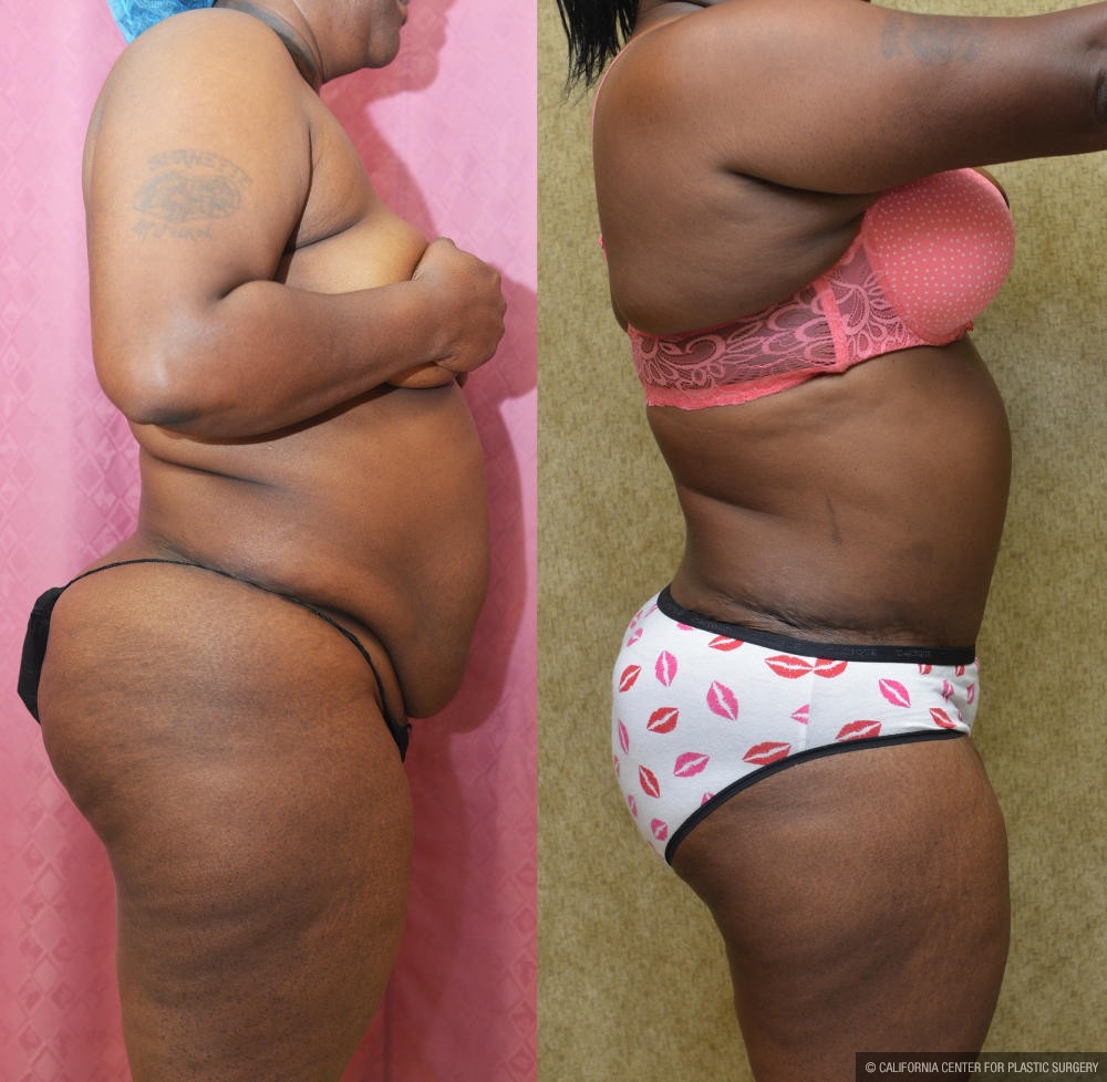 African American Tummy Tuck (Abdominoplasty) Before & After Patient #12190