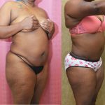 African American Tummy Tuck (Abdominoplasty) Before & After Patient #12190