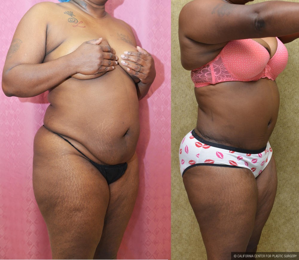 African American Tummy Tuck (Abdominoplasty) Before & After Patient #12190