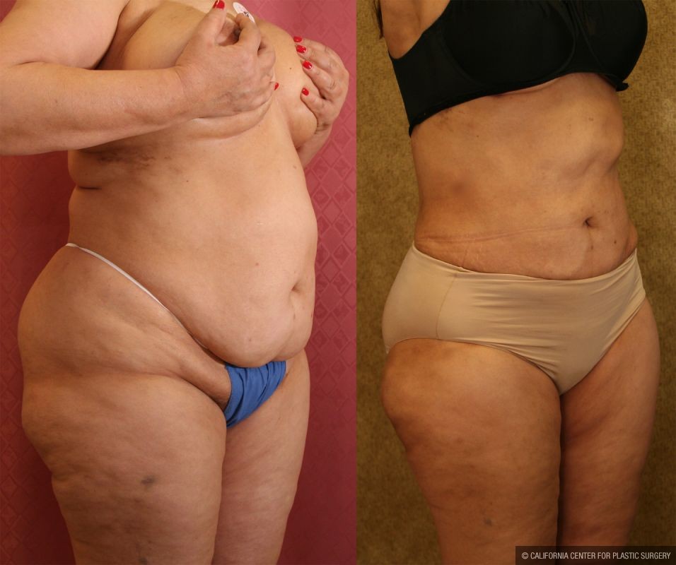 Liposuction of Buttocks Before & After Patient #12464