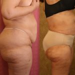 Liposuction of Buttocks Before & After Patient #12464