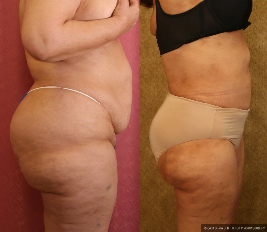 Liposuction of Buttocks Before & After Patient #12464