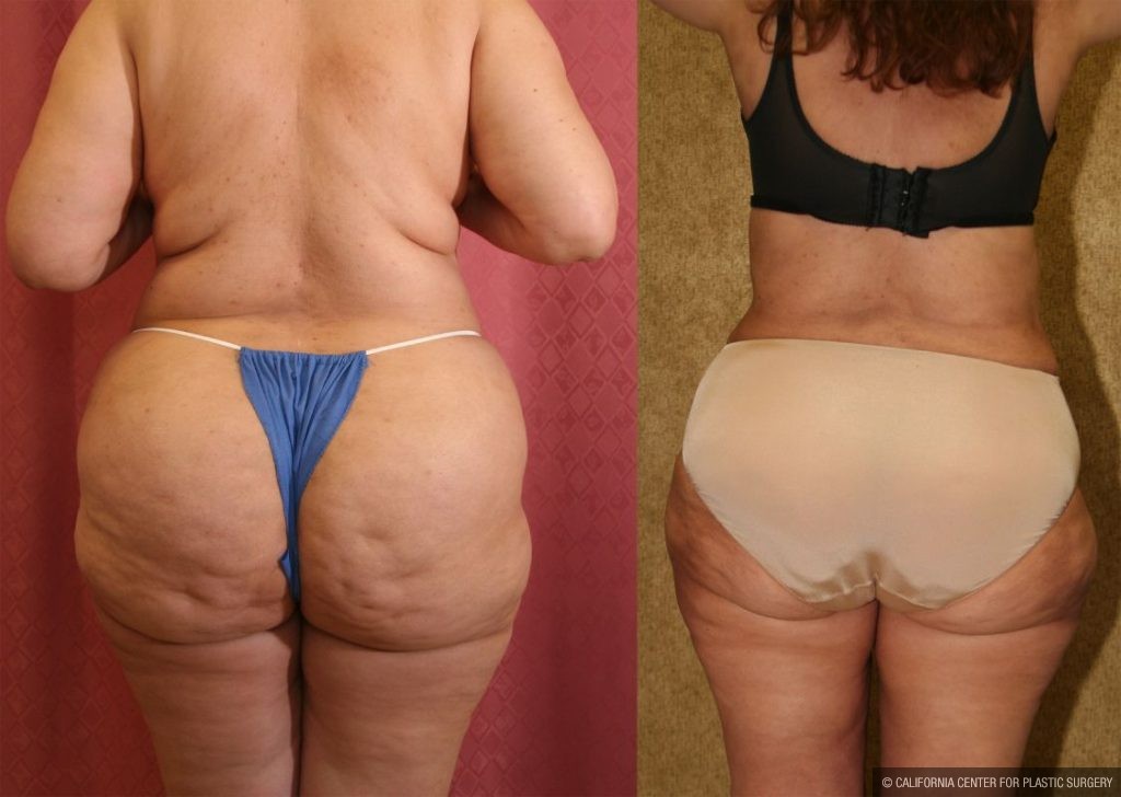 Liposuction of Buttocks Before & After Patient #12464