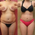 Liposuction Abdomen Medium Before & After Patient #12447
