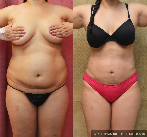 Liposuction Abdomen Medium Before & After Patient #12447