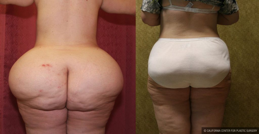 Liposuction of Buttocks Before & After Patient #12469