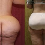 Liposuction of Buttocks Before & After Patient #12469