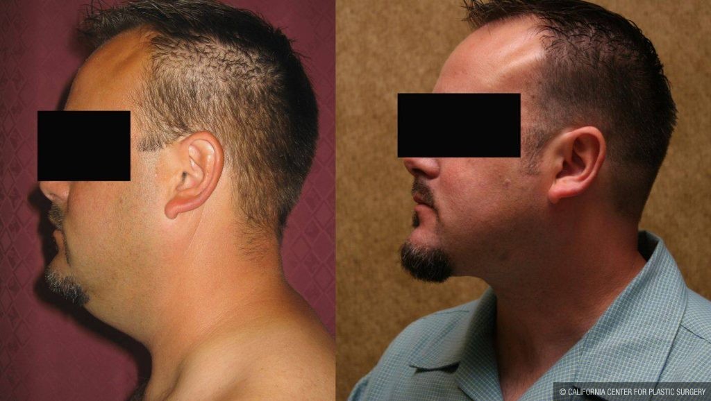 Male Neck & Face Liposuction Before & After Patient #12471