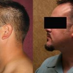 Male Neck & Face Liposuction Before & After Patient #12471