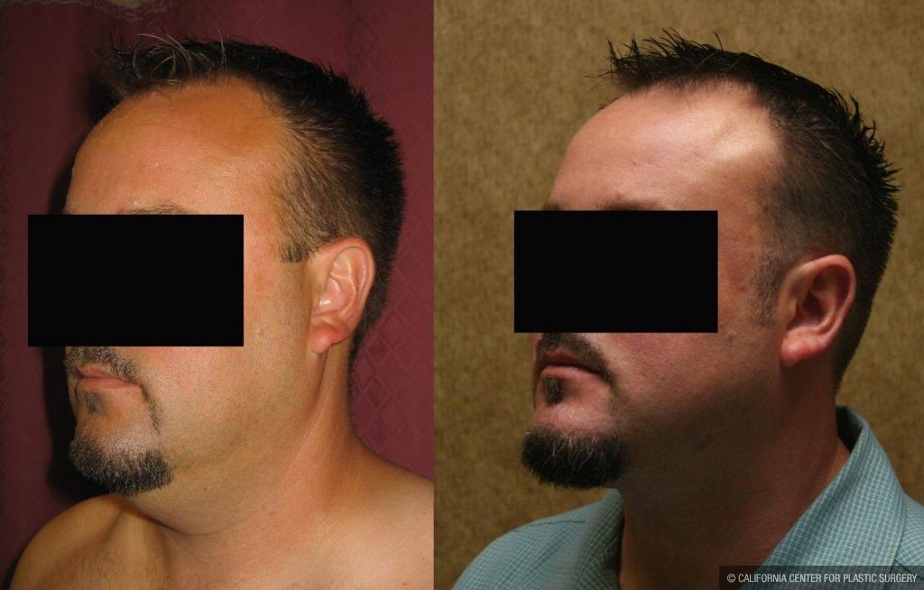 Male Neck & Face Liposuction Before & After Patient #12471