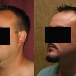 Male Neck & Face Liposuction Before & After Patient #12471