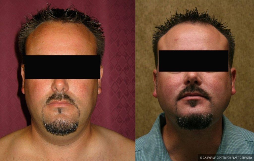 Male Neck & Face Liposuction Before & After Patient #12471