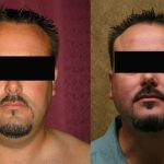 Male Neck & Face Liposuction Before & After Patient #12471