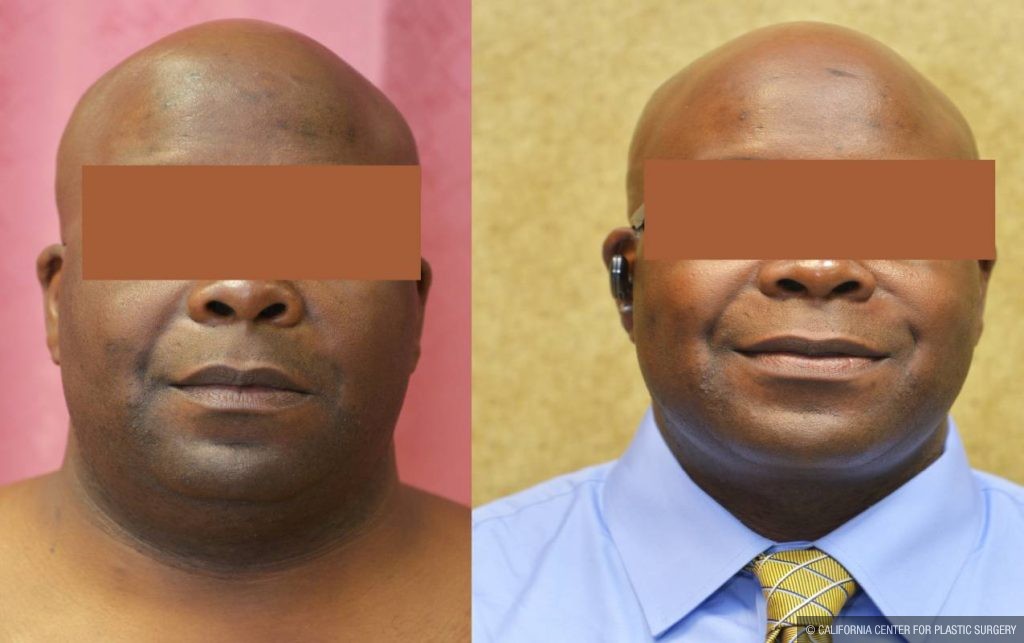 Male Neck & Face Liposuction Before & After Patient #12472