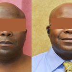 Male Neck & Face Liposuction Before & After Patient #12472