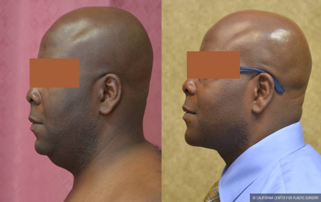 Male Neck & Face Liposuction Before & After Patient #12472