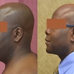 Male Neck & Face Liposuction Before & After Patient #12472