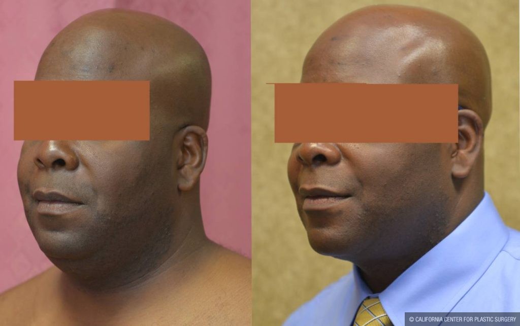 Male Neck & Face Liposuction Before & After Patient #12472