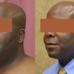 Male Neck & Face Liposuction Before & After Patient #12472