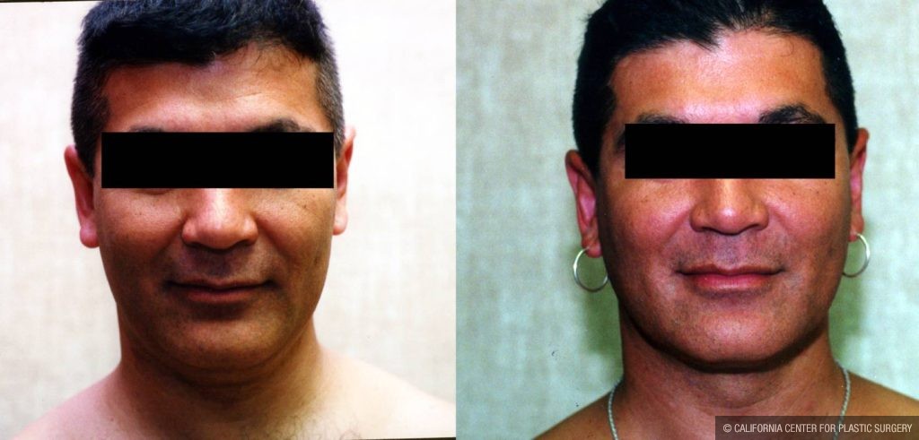 Male Neck & Face Liposuction Before & After Patient #12482