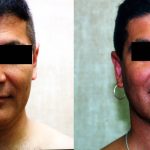 Male Neck & Face Liposuction Before & After Patient #12482