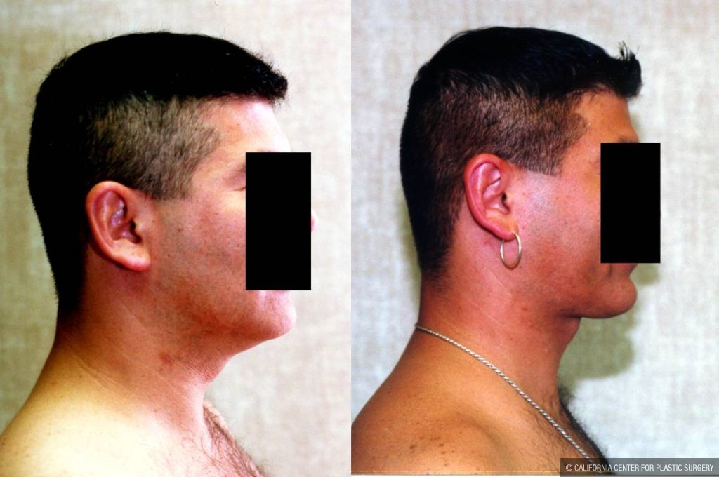 Male Neck & Face Liposuction Before & After Patient #12482