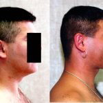 Male Neck & Face Liposuction Before & After Patient #12482