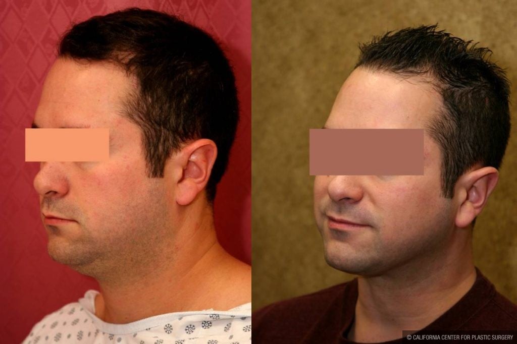 Male Neck & Face Liposuction Before & After Patient #12474