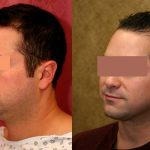 Male Neck & Face Liposuction Before & After Patient #12474