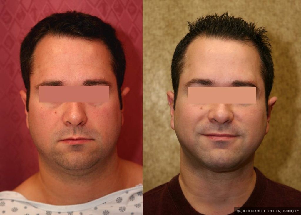 Male Neck & Face Liposuction Before & After Patient #12474
