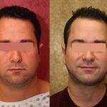 Male Neck & Face Liposuction Before & After Patient #12474