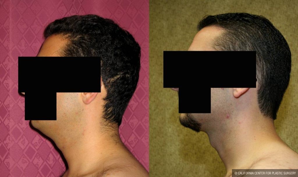 Male Neck & Face Liposuction Before & After Patient #12475