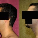 Male Neck & Face Liposuction Before & After Patient #12475