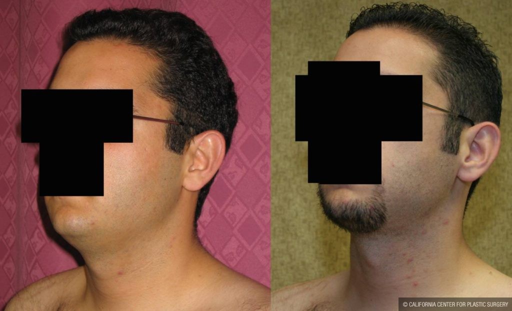 Male Neck & Face Liposuction Before & After Patient #12475