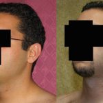 Male Neck & Face Liposuction Before & After Patient #12475