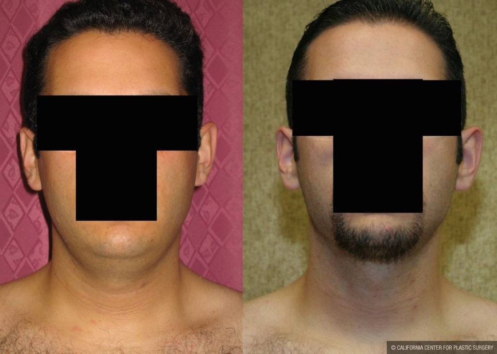 Male Neck & Face Liposuction Before & After Patient #12475