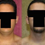 Male Neck & Face Liposuction Before & After Patient #12475