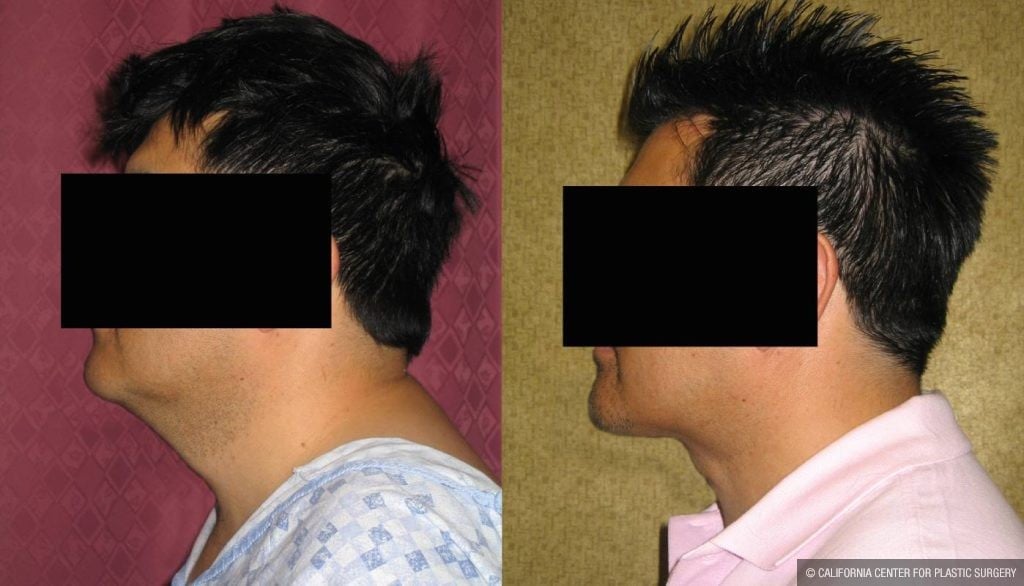 Male Neck & Face Liposuction Before & After Patient #12490