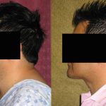 Male Neck & Face Liposuction Before & After Patient #12490