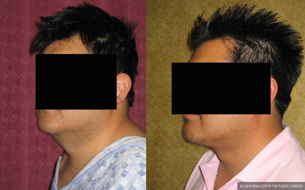 Male Neck & Face Liposuction Before & After Patient #12490